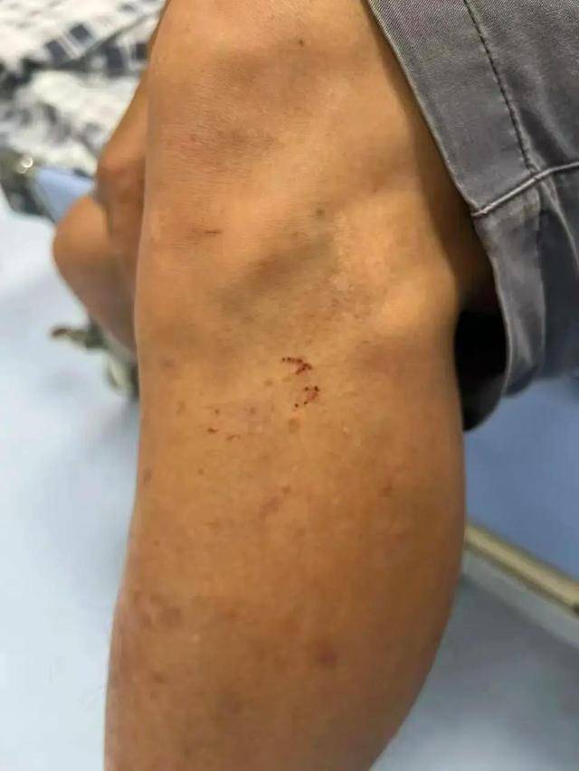 廣東62歲阿叔網(wǎng)魚網(wǎng)到2條眼鏡蛇<strong></p>
<p>宏鑫機(jī)械設(shè)備有限公司
</strong>，被咬傷后當(dāng)場(chǎng)打死，并打包提進(jìn)醫(yī)院:宏鑫機(jī)械設(shè)備有限公司
