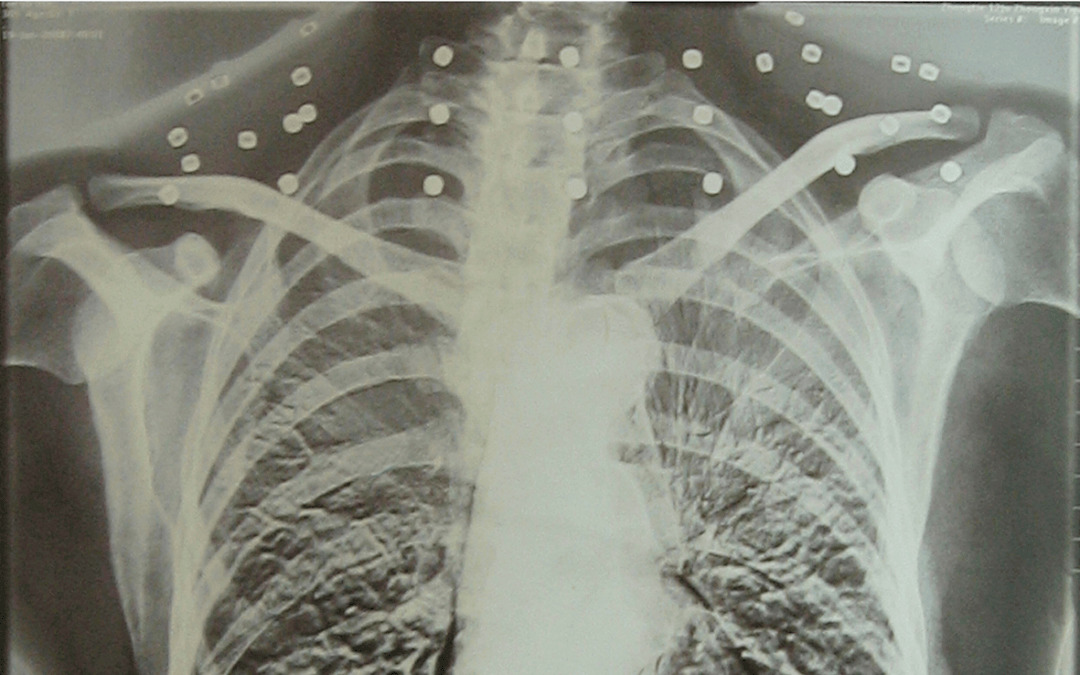 “老先生，您把項(xiàng)鏈取下來再做CT”:宏鑫機(jī)械設(shè)備有限公司
