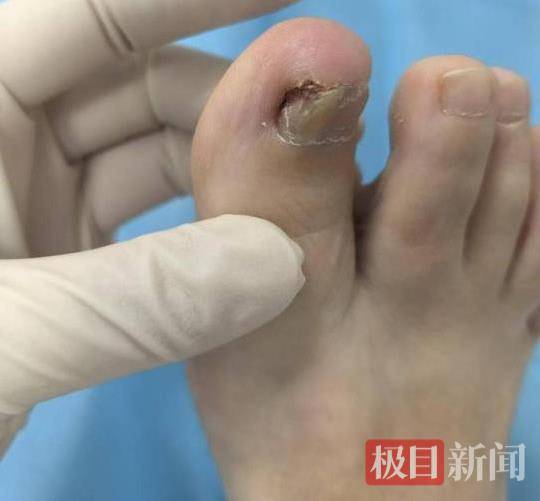 六旬女子被甲溝炎折磨了三年<strong></p>
<p>宏鑫機(jī)械設(shè)備有限公司
</strong>，專家30分鐘手術(shù)解難題:宏鑫機(jī)械設(shè)備有限公司
