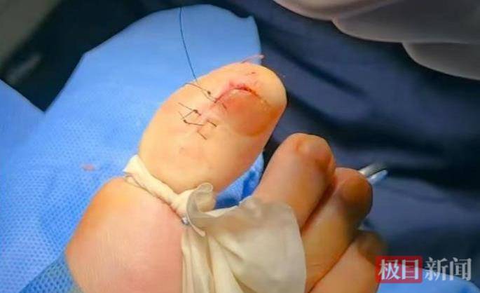 六旬女子被甲溝炎折磨了三年<strong></p>
<p>宏鑫機(jī)械設(shè)備有限公司
</strong>，專家30分鐘手術(shù)解難題:宏鑫機(jī)械設(shè)備有限公司
